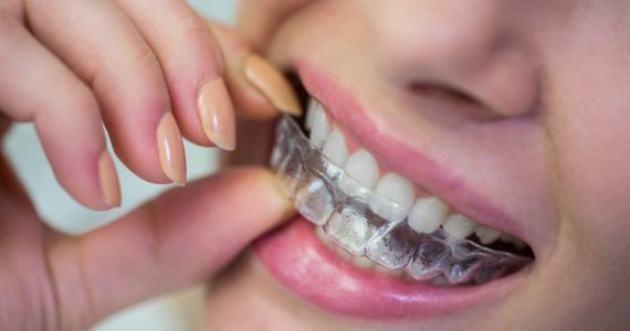 Clear Aligners In Yuma