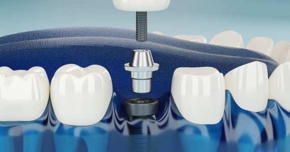 Dental Implants in Yuma