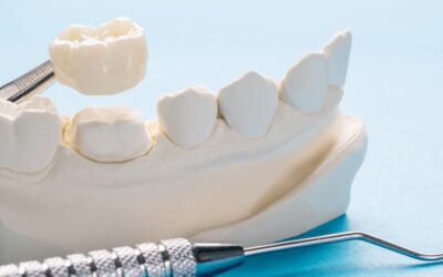 Why is a Dental Crown So Expensive