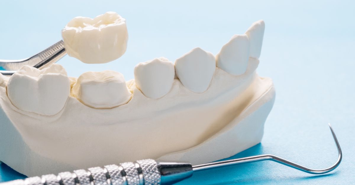 Why is a Dental Crown So Expensive