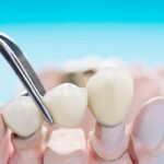 how to remove stains from dental bridges