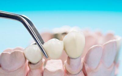 how to remove stains from dental bridges