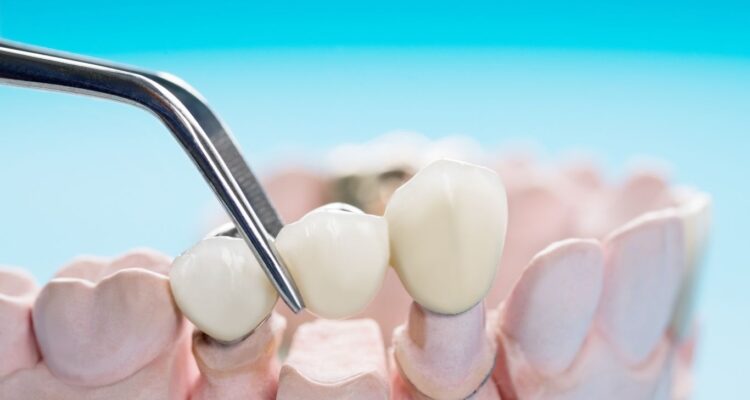 how to remove stains from dental bridges