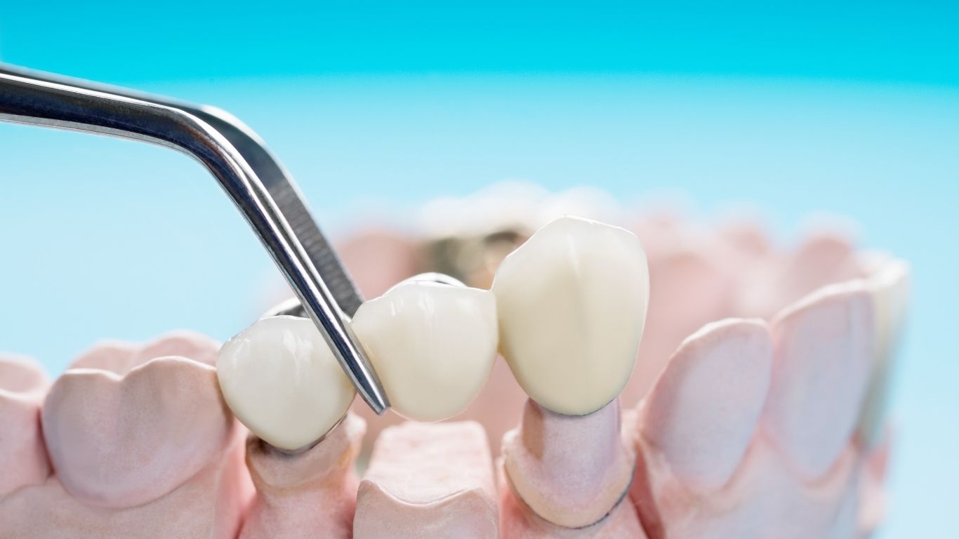 how to remove stains from dental bridges