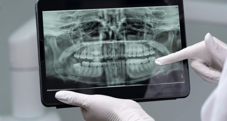 Can I Refuse Dental X-rays