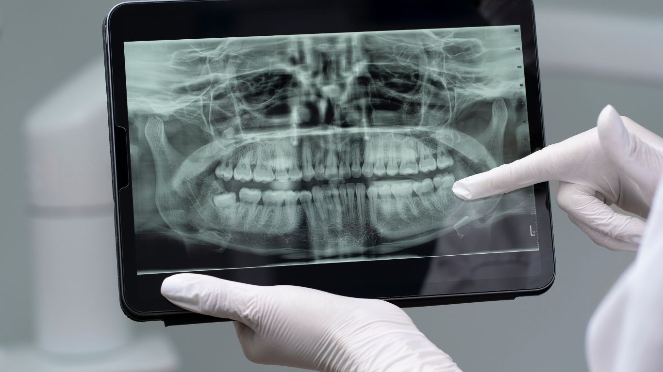 Can I Refuse Dental X-rays